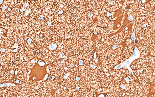 16C3 Tuber (Case 16) GFAP 40X