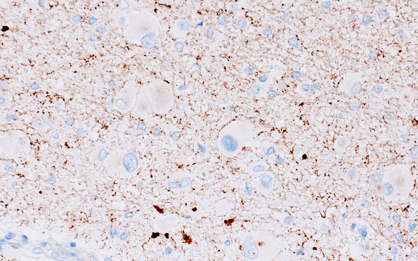 16D2 Tuber (Case 16) SYN 40X