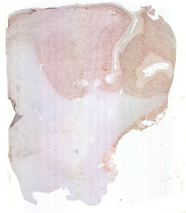 16E1 Tuber (Case 16) WM NeuN