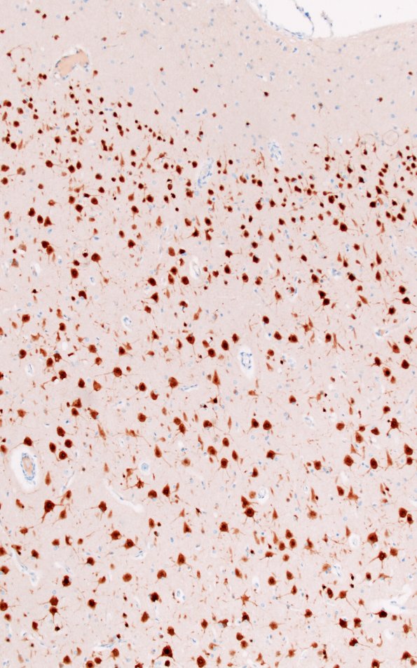 16E2 Tuber (Case 16) WM NeuN 10X 1