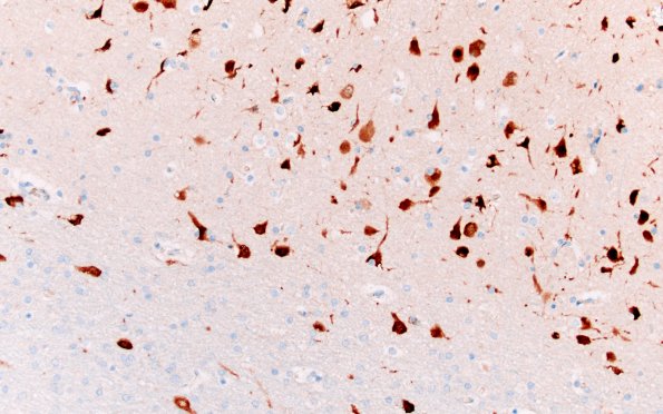 16E3 Tuber (Case 16) WM NeuN 20X 1