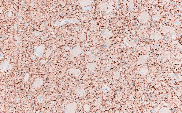 16F1 Tuber (Case 16) NF 20X