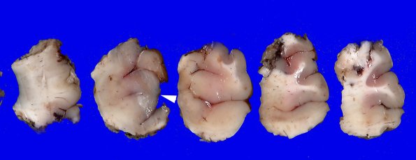 17A1 Tuber (Case 17) Gross 1