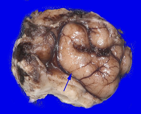 17A2 Tuber (Case 17)