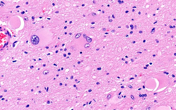 17B3 Tuber (Gene defect, Case 17) H&E 40X 5
