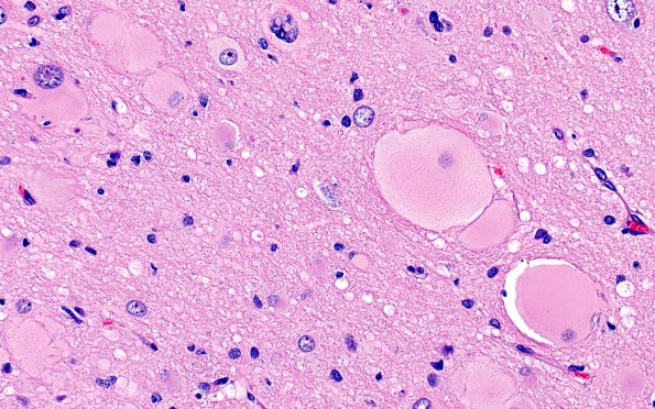 17B4 Tuber (Gene defect, Case 17) H&E 40X 3