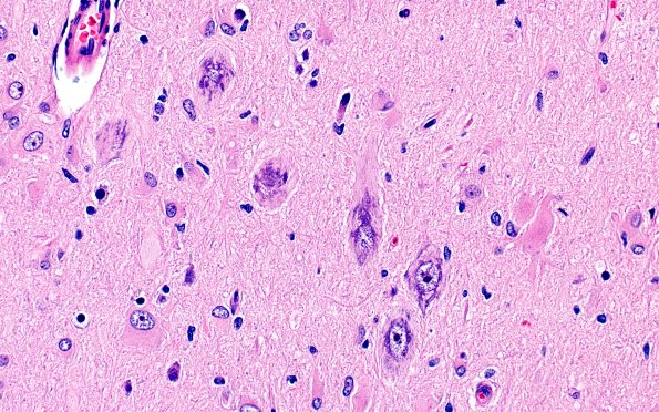 17B5 Tuber (Gene defect, Case 17) H&E 40X 1