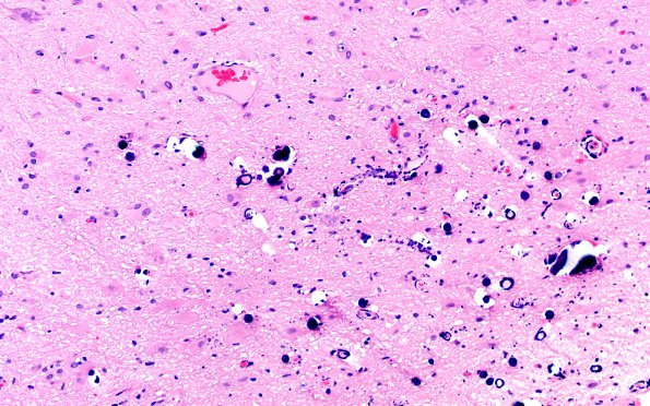 17B6 Tuber (Gene defect, Case 17) H&E 20X 2
