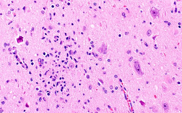 17B7 Tuber (Gene defect, Case 17) H&E 40X 4