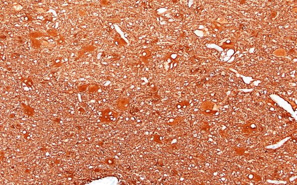 17C1 Tuber (Gene defect, Case 17) GFAP 20X 1A