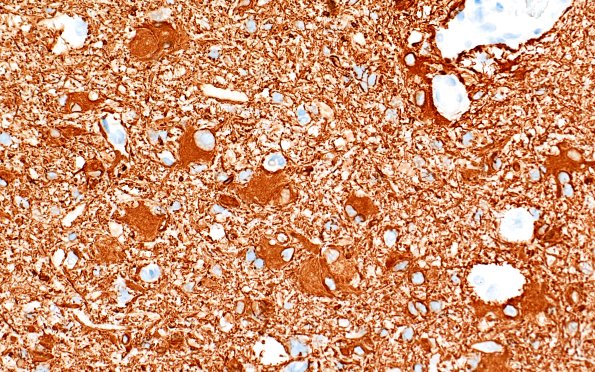 17C2 Tuber (Gene defect, Case 17) GFAP 40X 1