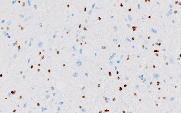 17D1 Tuber (Gene defect, Case 17) Olig2 40X 1