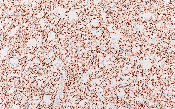 17E1 Tuber (Gene defect, Case 17) NF 20X 1