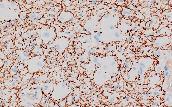 17E2 Tuber (Gene defect, Case 17) NF 40X 1