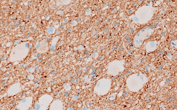 17E3 Tuber (Gene defect, Case 17) NF 40X 2