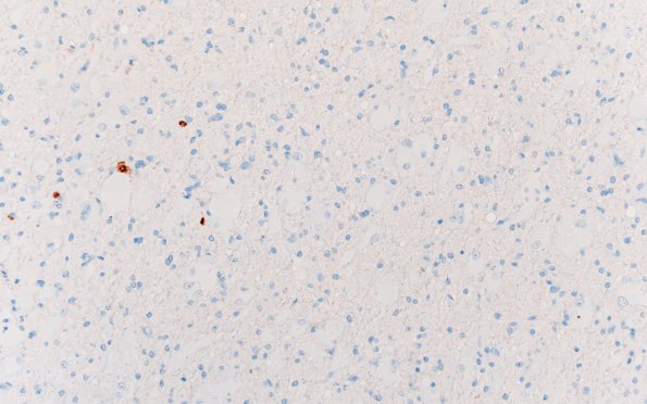 17F1 Tuber (Gene defect, Case 17) NeuN 20X 1