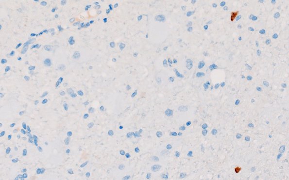 17F2 Tuber (Gene defect, Case 17) NeuN 40X 2