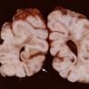 1A1 Tuberous Sclerosis (Case 1) Gross_12