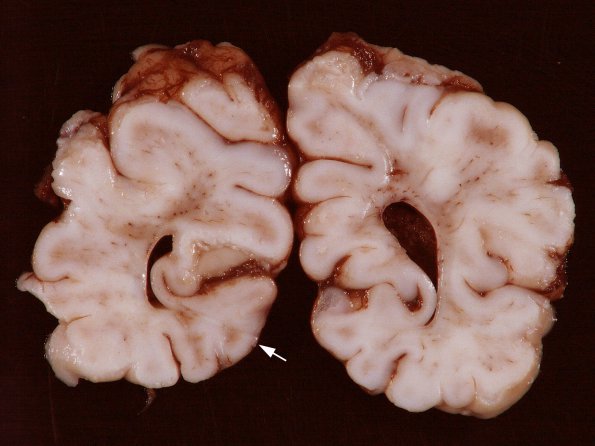 1A1 Tuberous Sclerosis (Case 1) Gross_12