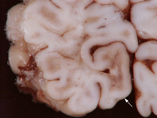 1A2 Tuberous Sclerosis (Case 1) Gross_16