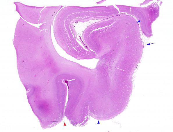 1B1 Tuberous Sclerosis (Case 1) H&E N19 whole mount (2)