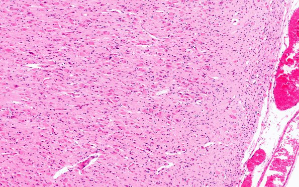 1B2 Tuberous Sclerosis (Case 1) H&E N19 1