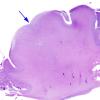 1B3 Tuberous Sclerosis (Case 1) H&E N18 whole mount