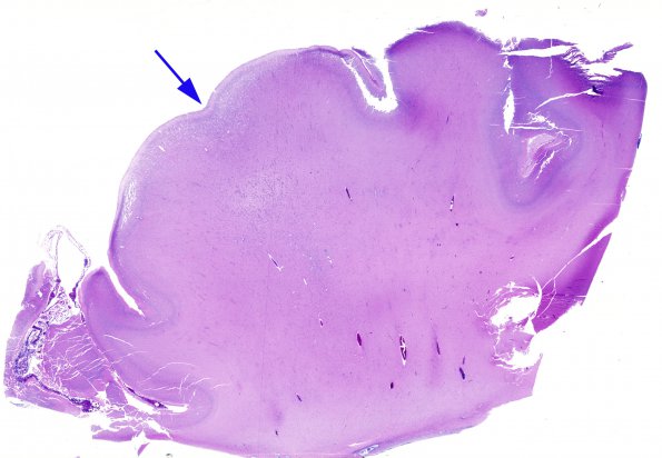 1B3 Tuberous Sclerosis (Case 1) H&E N18 whole mount