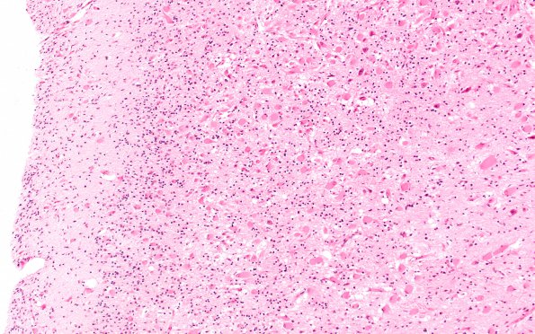 1B4 Tuberous Sclerosis (Case 1) H&E N18 whole mount