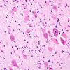 1B5 Tuberous Sclerosis (Case 1) H&E N18 1