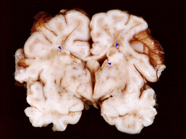 1C1 Tuberous Sclerosis (Case 1) Gross_5