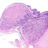 1D2 Tuberous Sclerosis (Case 1) H&E N11 1