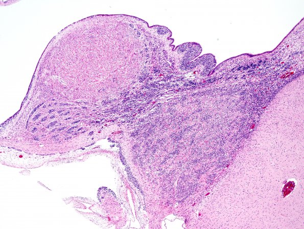 1D2 Tuberous Sclerosis (Case 1) H&E N11 1