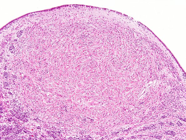 1D3 Tuberous Sclerosis (Case 1) H&E N11 3