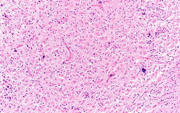 1D4 Tuberous Sclerosis (Case 1) H&E N11 3