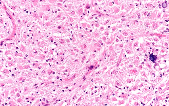 1D5 Tuberous Sclerosis (Case 1) H&E N11 3