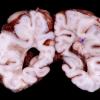 1E1 Tuberous Sclerosis (Case 1) Gross_10