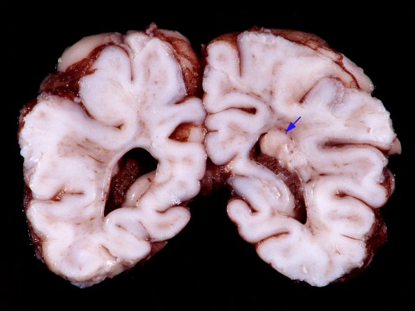 1E1 Tuberous Sclerosis (Case 1) Gross_10