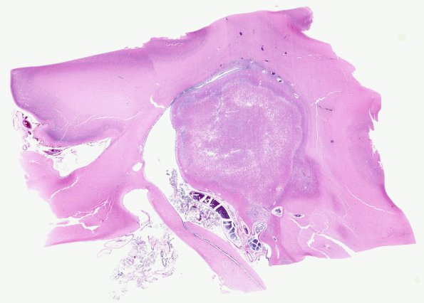 1F1 Tuberous Sclerosis (Case 1) H&E N14 whole mount