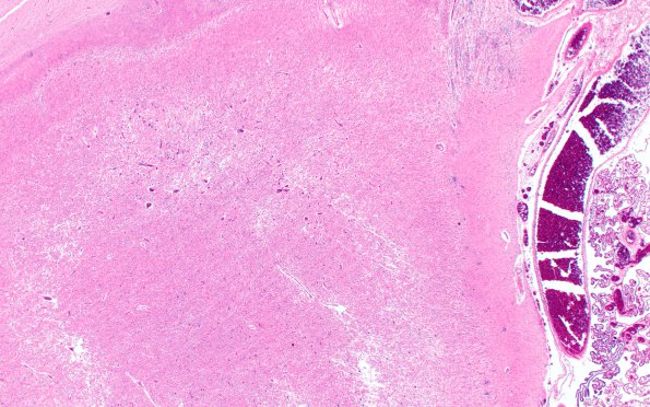 1F2 Tuberous Sclerosis (Case 1) H&E N14 whole mount