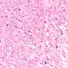 1F3 Tuberous Sclerosis (Case 1) H&E N14 whole mount (2)