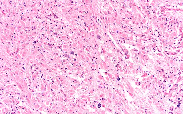 1F3 Tuberous Sclerosis (Case 1) H&E N14 whole mount (2)