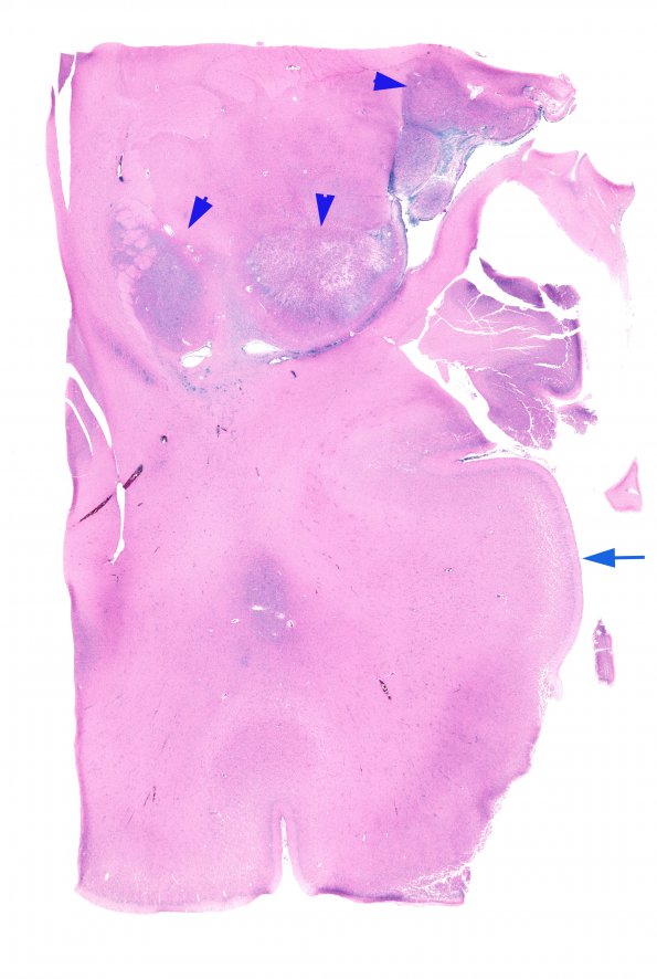 1F4 Tuberous Sclerosis (Case 1) H&E N12 Left whole mount