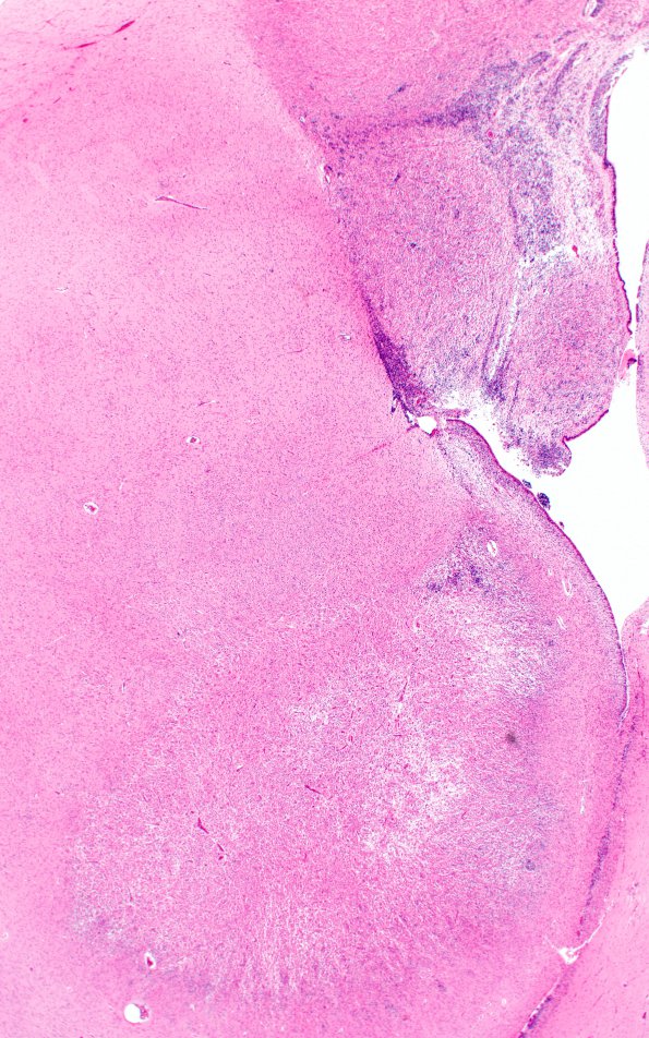 1F5 Tuberous Sclerosis (Case 1) H&E N12 Left whole mount