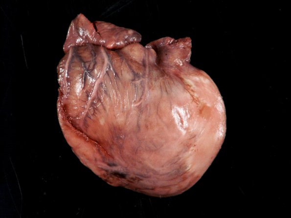 1G1 Tuberous Sclerosis (Case 1) Rhabdomyoma_1