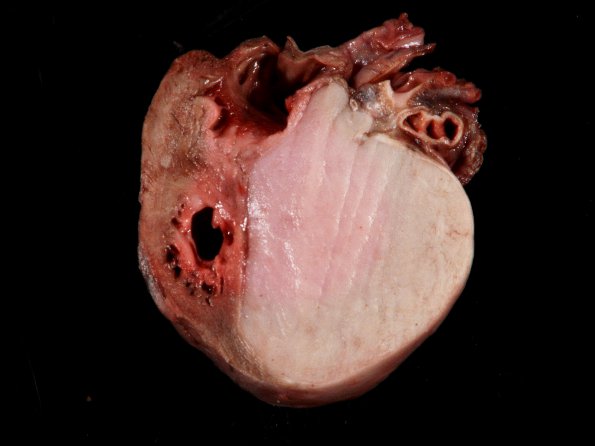 1G2 Tuberous Sclerosis (Case 1) Rhabdomyoma_2