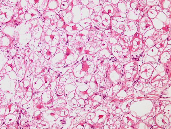 1H Tuberous Sclerosis (Case 1) Rhabdomyoma H&E 2