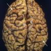 2A1 Tuberous Sclerosis (Case 2) 13