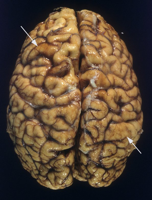 2A1 Tuberous Sclerosis (Case 2) 13