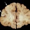 2A2 Tuberous Sclerosis (Case 2) 5a